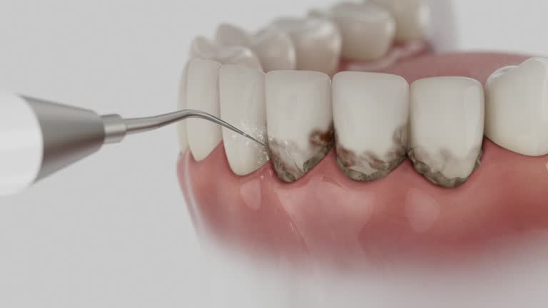 Trusted Wisdom Tooth Removal service in Saybrook-on-the-Lake, OH - Dentist Open Now